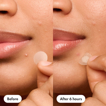 Hydrocolloid Acne Dots for Fast Blemish Care