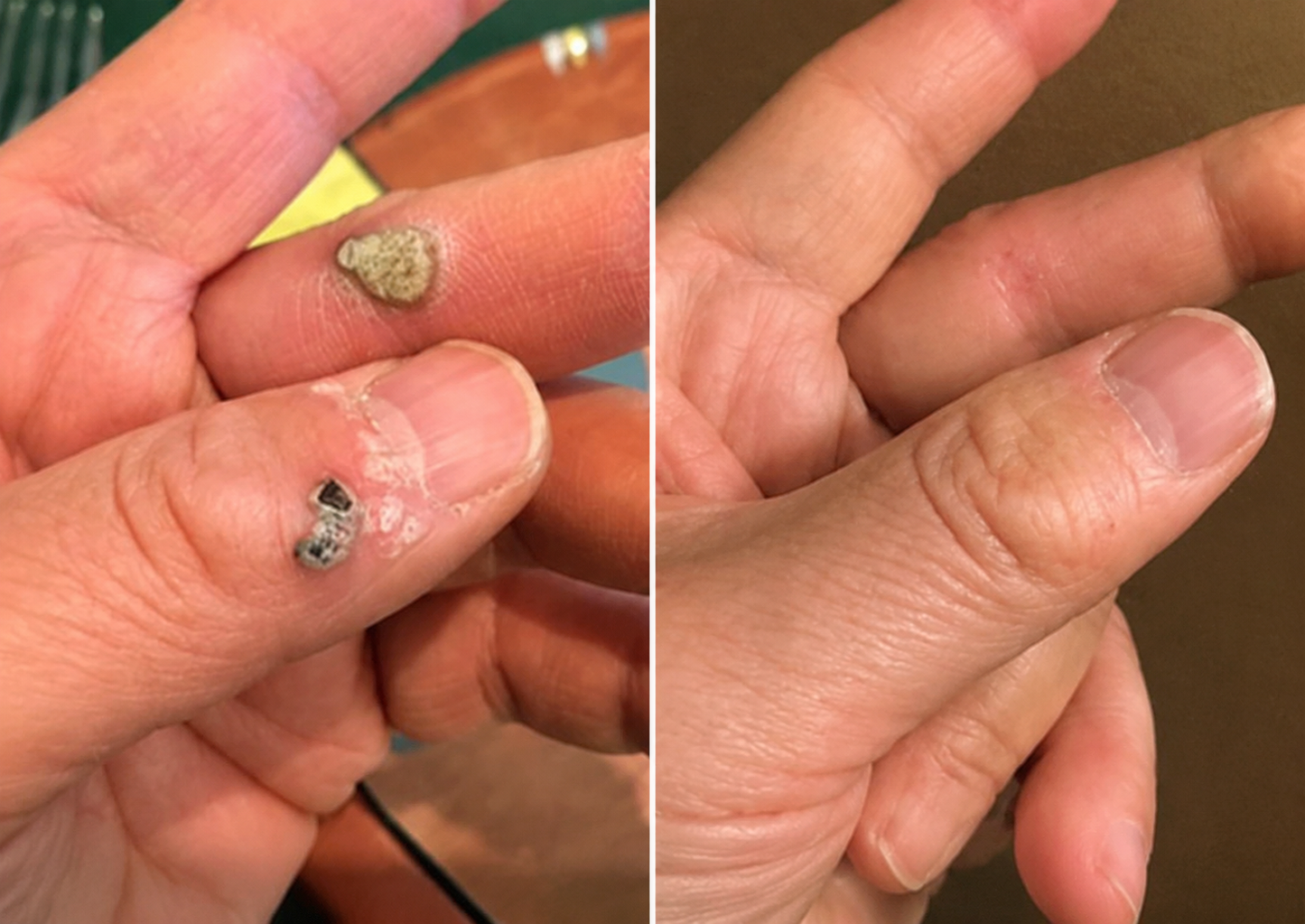 2-in-1 Microneedle Patch🧴 Clear Blemishes, Moles & Warts, Fade Scars, Invisible Face Body Use