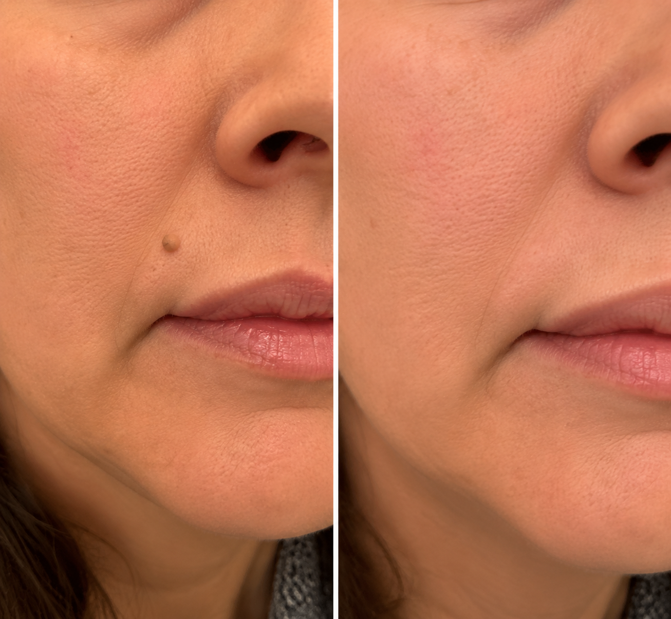 2-in-1 Microneedle Patch🧴 Clear Blemishes, Moles & Warts, Fade Scars, Invisible Face Body Use