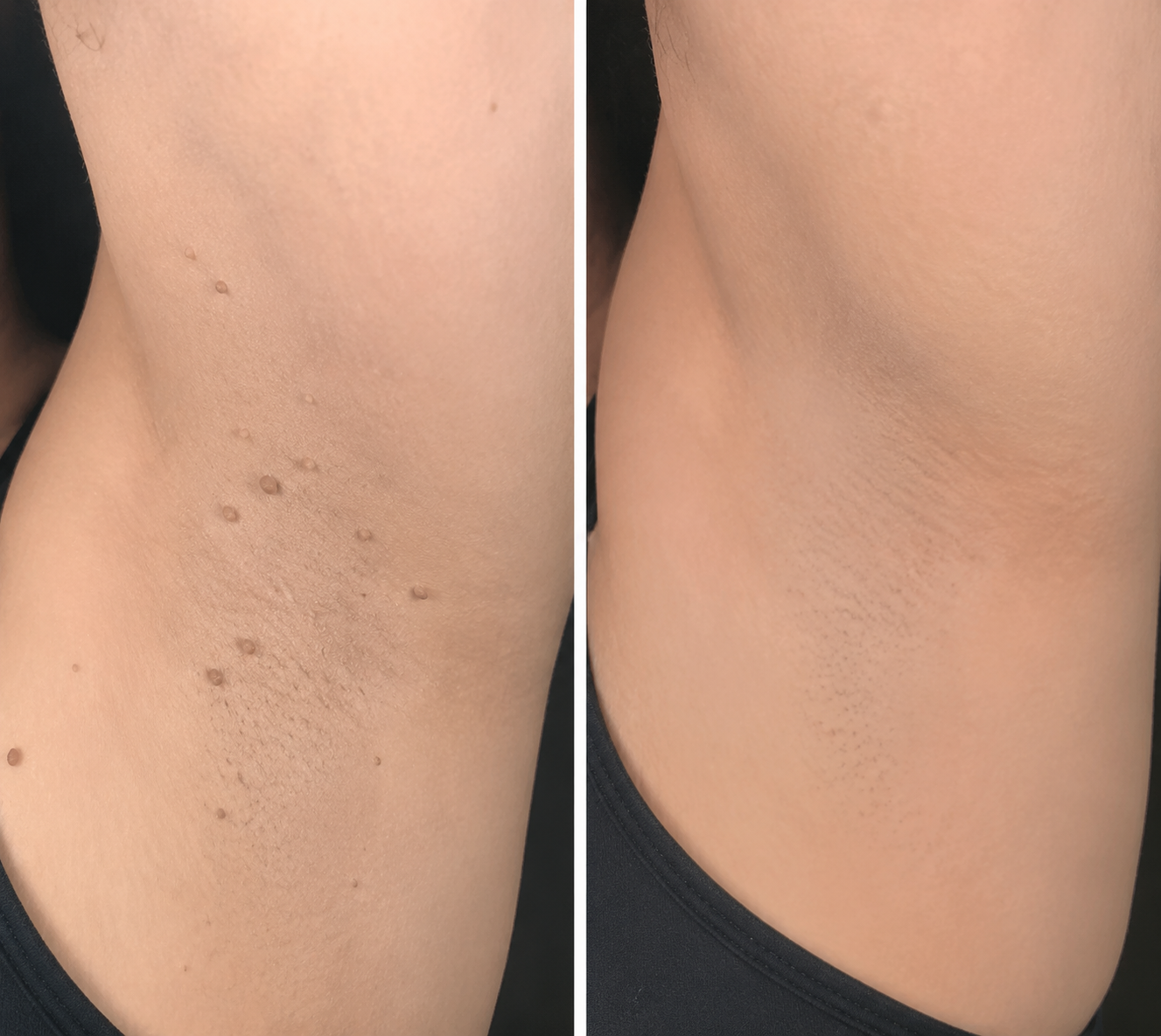 2-in-1 Microneedle Patch🧴 Clear Blemishes, Moles & Warts, Fade Scars, Invisible Face Body Use